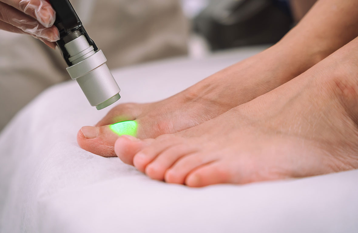Tractament podològic amb làser aplicat en el peu a Podologia Balmes 74, Igualada, per a una cura precisa i indolora.