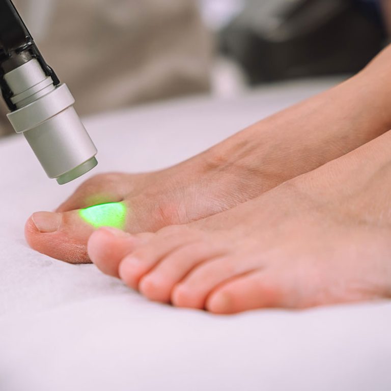 Tractament podològic amb làser aplicat en el peu a Podologia Balmes 74, Igualada, per a una cura precisa i indolora.