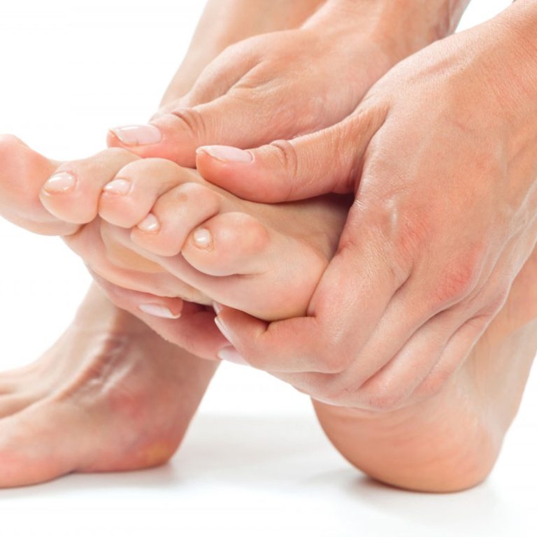 Peu amb deformitat rebregada que necessita ortesis de silicona per a la correcció i alleujament del dolor, tractament especialitzat a Podologia Balmes 74.